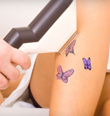 Alternative Tattoo Removal