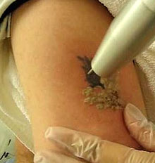 Blink Tattoo Removal