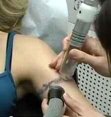 Cost of Tattoo Removal
