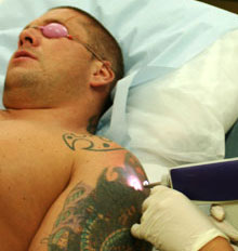 Dermaeraze Tattoo Removal