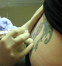 Free Tattoo Removal Options