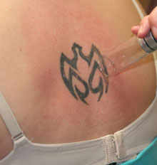Is Tattoo Removal Safe
