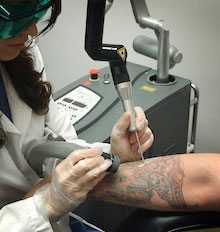 Laser Tattoo Removal