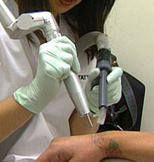 Laserase Tattoo Removal