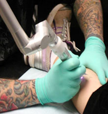 Naturalaser Tattoo Removal