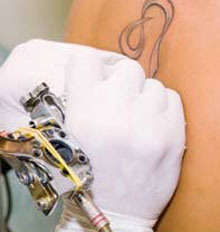 NHS Tattoo Removal