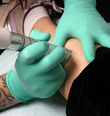 Rejuvi Tattoo Removal