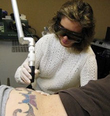 Side Effects of Tattoo Removal