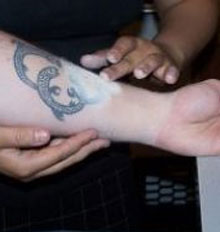 Tat B Gone Tattoo Removal