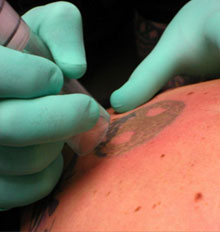 Tattoo Removal Cream vs Laser