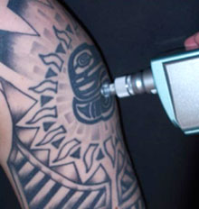 Tattoo Removal Dermabrasion