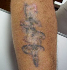 Tattoo Removal Post Treatment Facts