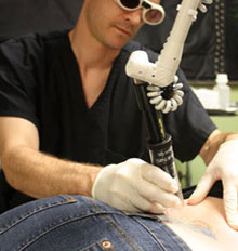 Tattoo Removal Process