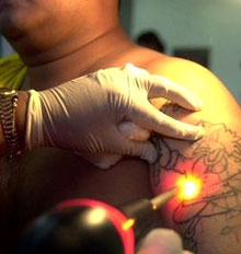 Tattoo Removal Replacements