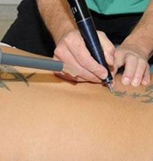 Tattoo Removal Specialists