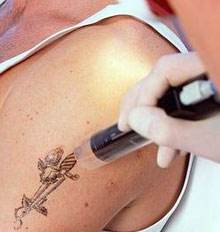 The Body Clinic Tattoo Removal