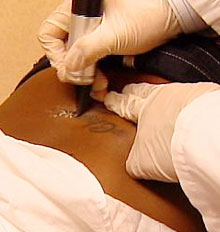 What Tattoo Removal is the Quickest
